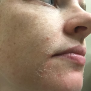 Dry Flaky Skin Around Mouth 35