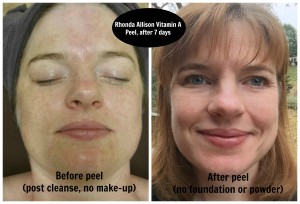 Rhonda Allison Vitamin A Peel Before and After