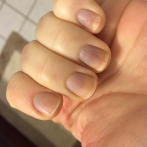 Nails may turn blue during an episode and over time,  nails might develop ridges related to Raynaud's.